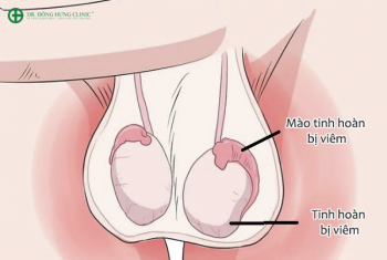 Bệnh viêm mào tinh hoàn là gì? Nguyên nhân và cách điều trị