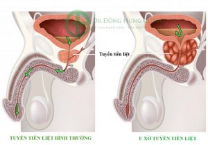 Chữa phì đại tuyến tiền liệt ở đâu uy tín, an toàn - Dr Đông Hưng