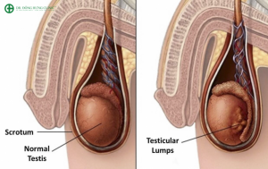 Điều trị viêm tinh hoàn ở đâu hiệu quả, uy tín - Dr Đông Hưng