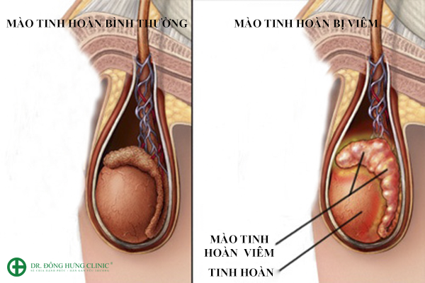 nhan-biet-benh-viem-mao-tinh-hoan