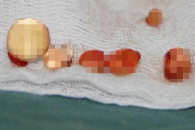 Bien dang vi tiem silicone long anh 3