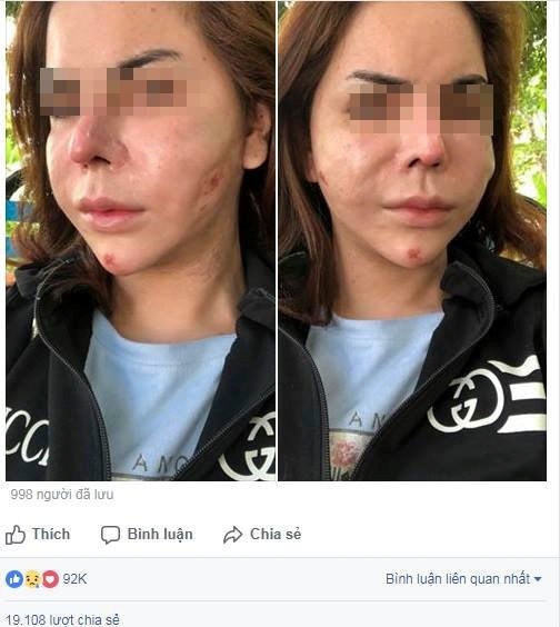 Bien dang vi tiem silicone long anh 4