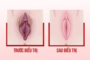 phau-thuat-cat-moi-toan