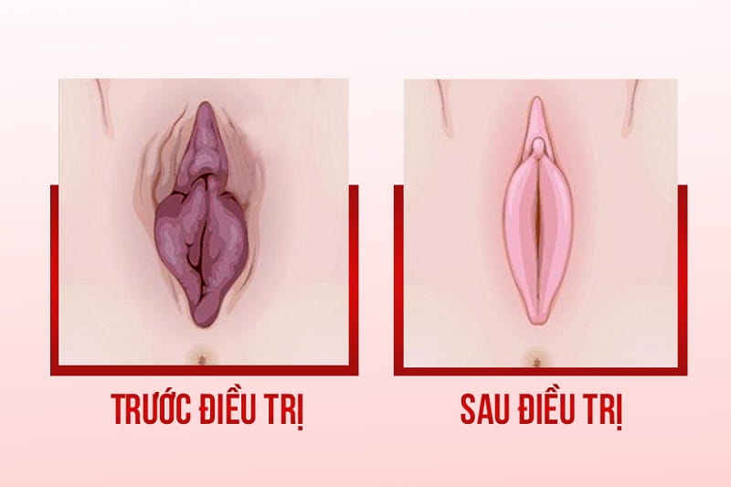 Hình ảnh kết quả phẫu thuật thẩm mỹ vùng kín