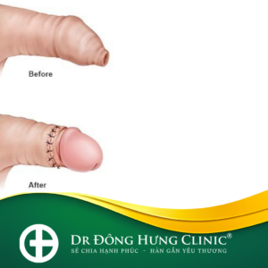 cắt bao quy đầu