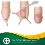 cắt bao quy đầu