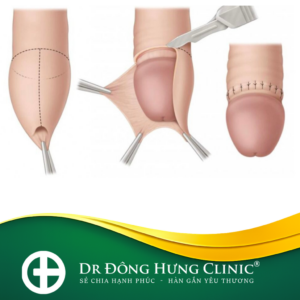 cắt bao quy đầu