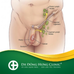 ung thư bao quy đầu