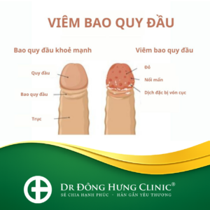 viêm bao quy đầu