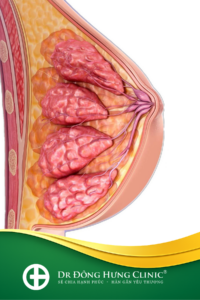 sữa - sau sinh - hậu sản - vú