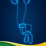 bao quy đầu - hẹp - ngắn - viêm- cắt - sẹo