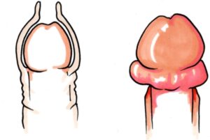 seo xơ bao quy đầu