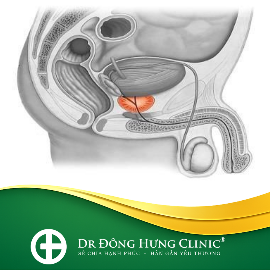 bao quy đầu - hẹp - ngắn - viêm- cắt - sẹo