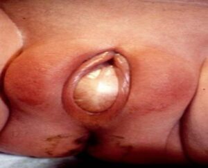 màng trinh không thủng