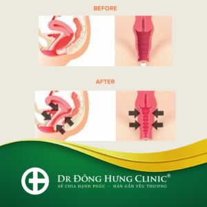 thu hẹp -thẩm mỹ- phục hồi- trẻ hóa - cùng kín- cô bé