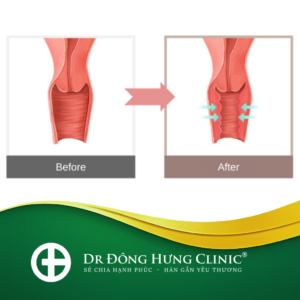 thu hẹp -thẩm mỹ- phục hồi- trẻ hóa - cùng kín- cô bé