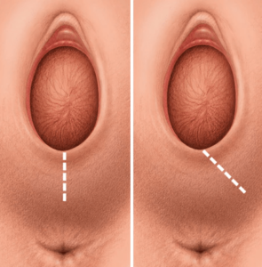 hinh-anh-vet-rach-tang-sinh-mon-min