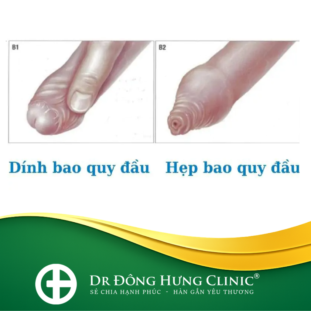bao quy đầu - hẹp - ngắn - viêm- cắt - sẹo