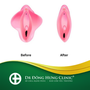 tạo hình môi bé- tạo hình môi lớn -thẩm mỹ- phục hồi- trẻ hóa - cùng kín- cô bé