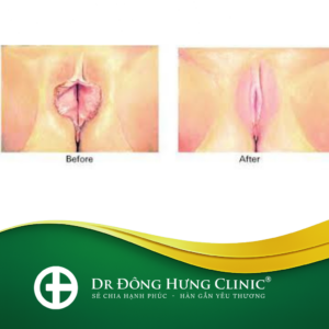 tạo hình môi bé- tạo hình môi lớn -thẩm mỹ- phục hồi- trẻ hóa - cùng kín- cô bé