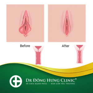 thu hẹp âm đạo- tầng sinh môn -thẩm mỹ- phục hồi- trẻ hóa - cùng kín- cô bé