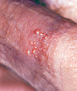 herpes sinh dục nam