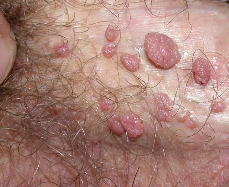 HPV Wart