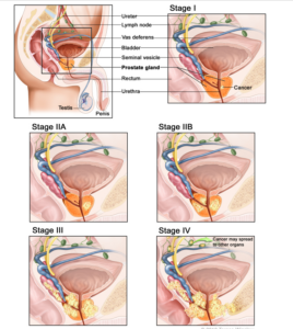 ung thư tuyến tiền liệt